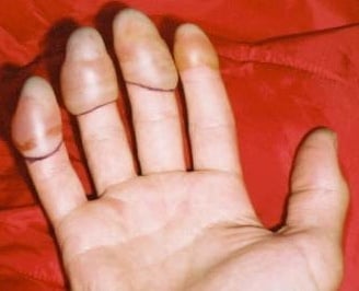 Hand recovering from frostbite Hand recovering from frostbite